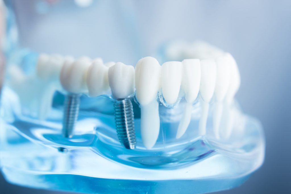 exemplo de prótese dentárias